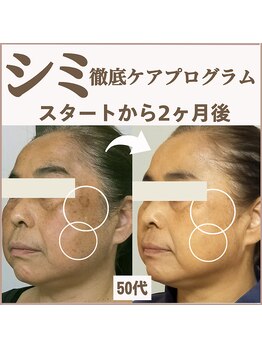 スイッチ(Switch)/シミ徹底ケアプログラム2ヶ月で!