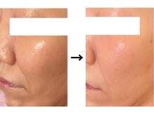 ドクターエイジレス(DR.AGELESS)/リアボーテフェイシャル/1年