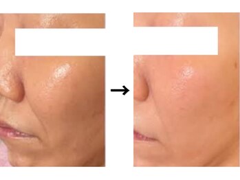 ドクターエイジレス(DR.AGELESS)/リアボーテフェイシャル/1年