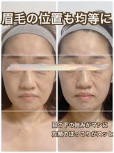 エヌラボ(N.LABO)/小顔３回アフター