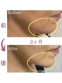 シーフェイス(see face)/引き上げる！シャープな顎に