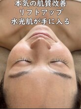 マヴィ くずは店(MavY.)/ノンニードル水光注入の秘密