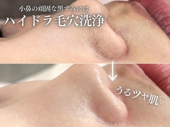 フェイシャルヴィム(FACIAL VIM)/毛穴洗浄で黒ずみ・いちご鼻撃退