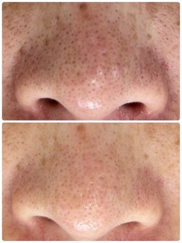 アンド ユー(and.yu)/シミケア・美肌コース2回　毛穴