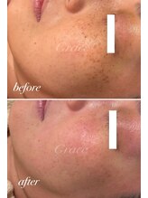 グレイス/最新光フォト