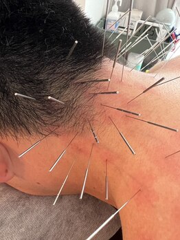 けんたろう鍼灸院の写真/本気で痛み・症状を改善したい方必見!鍼の本数と太さが10倍以上★”コリ”を直接とらえ根本改善。