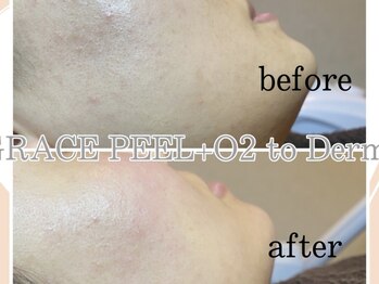 イヨヨ(iyoyo)/BeforeAfter