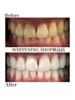 ホワイトニングショップ 妙高店(whiteningshop)/【before after】ここまで白く!