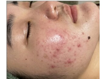 リベル 名古屋(Lebelle:)/ハーブピーリング 名古屋