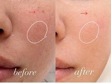 ミランサ ギンザ(MIRANSA GINZA)/リアボーテ1年間のお肌変化♪