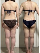 ヨルエステ(yoru aesthe)/【ブライダル、上半身痩せ】