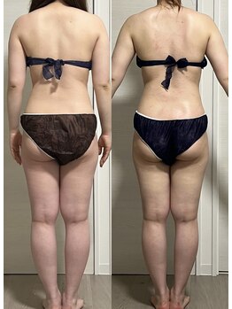 ヨルエステ(yoru aesthe)/【ブライダル、上半身痩せ】