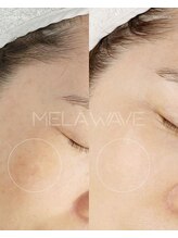 ナチュラル グロウ 木更津(NATURAL GLOW)/プラズマ美白