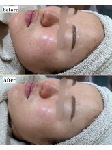 ソワナ(soina)/【神楽坂駅/フェイシャル/毛穴】