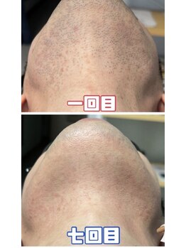 リラ 都城店(Lilas)/ヒゲ脱毛（顎下）