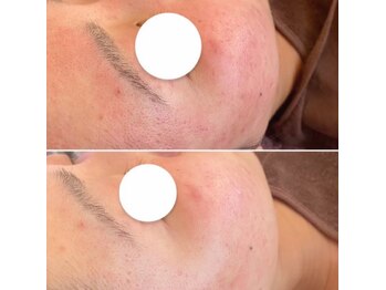 サロン ド チョコ(SALON DU CHOCO)/赤み軽減