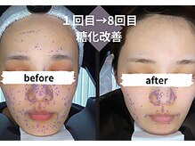 サロンスペース/30代女性　肌分析《糖化改善》