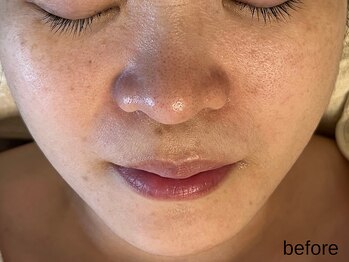 サロン ド エメ(salon de aimer)/【Before】小皺、毛穴改善を