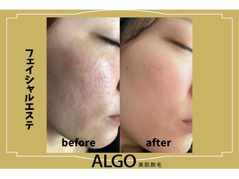 アルゴ 山口宇部店(ALGO)/肌質改善フェイシャルエステ