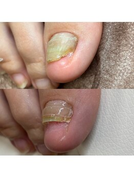 巻き爪矯正１回目（右親指）