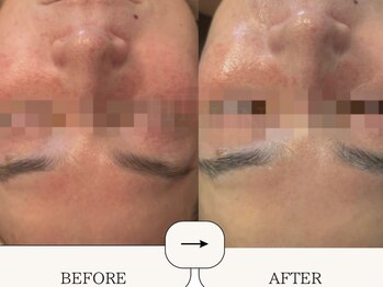 ハイフン(HIFUN)/毛穴/赤み/ニキビケア