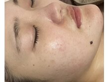 リベル 名古屋(Lebelle:)/ハーブピーリング　名古屋