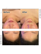 スキンホリック 恵比寿駅前店(SKIN HOLIC)/フェイスラインもスッキリ！