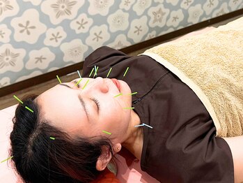 あやせ駅前ひだまり整骨院の写真/【鍼革命★美容鍼を気軽に♪】敷居の高い美容鍼を驚きの価格に！小顔は作る時代！美容鍼デビューは当院で！