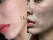 ミニョン(Mignon)/脱ファンデでノーファンデに