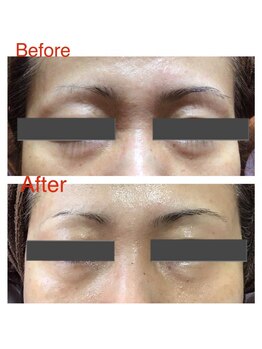 エヴァーグレース 河原町店/京都河原町の毛穴改善美肌サロン