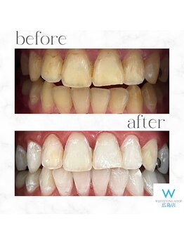ホワイトニングショップ 広島店(WHITENING SHOP)/【ホワイトニング】Before After