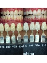 トウキョースワーズ 渋谷店(TOKYO SWRS)/#ホワイトニング #渋谷 #池袋