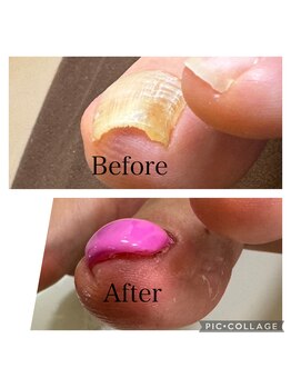 たけ子ビューティーサロン 川崎店(たけ子beauty salon)/巻き爪ケア