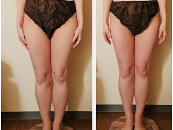 マナ(mana)/脚のむくみ解消初回体験