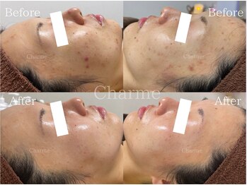 シャルム(Charme.)/陶肌ハーブピーリング(症例写真)