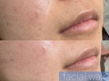 レーヴ(REVE)/フェイシャルWAX（頬・口周り）