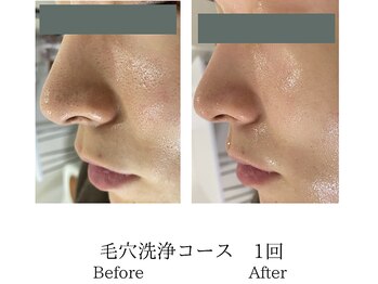 メンズミーシェ(Men's Meshie)/鼻の黒ずみには毛穴大洗浄エステ