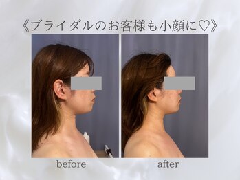 ジュプン 長崎/小顔筋膜のお客様！