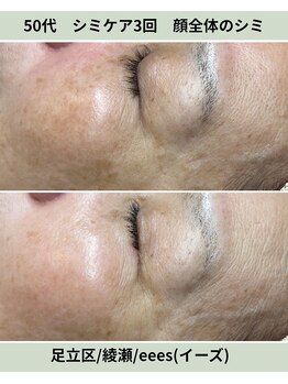 イーズ(eees)/顔全体のシミケア