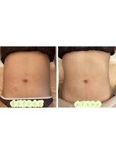 ルミナエステ(LUMINA ESTH)/脂肪分解剤レモンボトル 