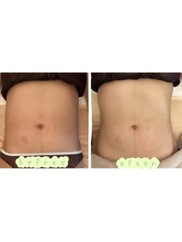 ルミナエステ(LUMINA ESTH)/脂肪分解剤レモンボトル