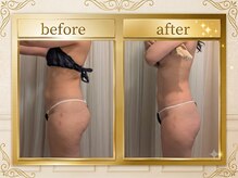 ポノ(pono)/WINBACK施術★BeforeAfter