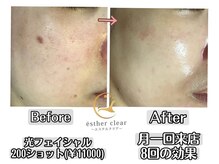 エステルクリア(esther clear)/マスクを取った肌に自信を