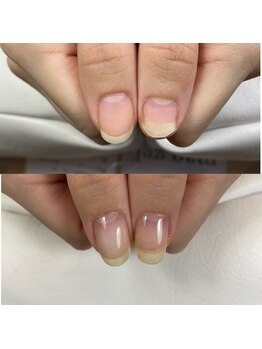 自爪育成/剥離爪