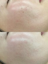 トラレス(Trouless)/