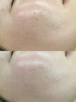 トラレス(Trouless)/