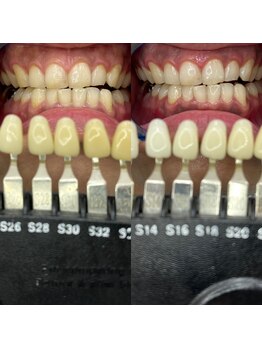 トウキョースワーズ 渋谷店(TOKYO SWRS)/#ホワイトニング #渋谷 #池袋