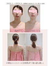 トゥインクル 麻布(twinkle)/麻布十番/シンメトリー小顔矯正