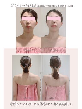 トゥインクル 麻布(twinkle)/麻布十番/シンメトリー小顔矯正