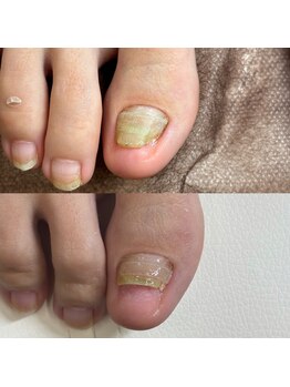 巻き爪矯正1回目(右親指)